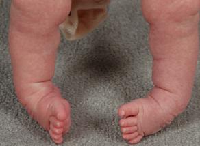 CTEV (Clubfoot)